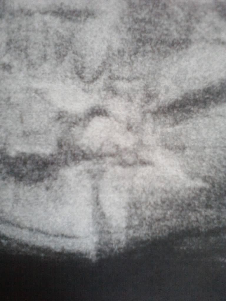 Pelops had a hole in his right shoulder, because Demeter ate it (long story) ... Image01182011144253 acroos the floor naked. acroos the floor naked russian naked girl